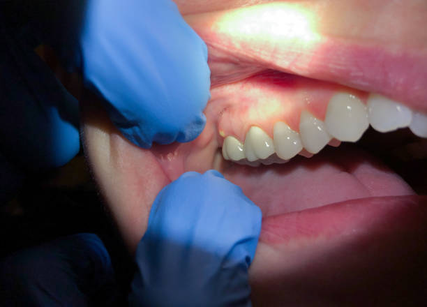 Best Emergency Dentist for Lost Fillings or Crowns in Idaho Springs, CO